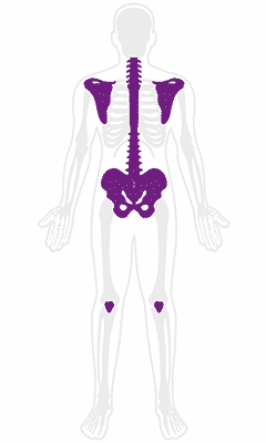 Spondyloarthropathies